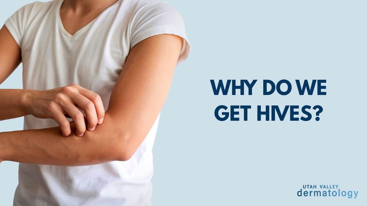 Why Do Hives Happen?? | Utah Valley Dermatology