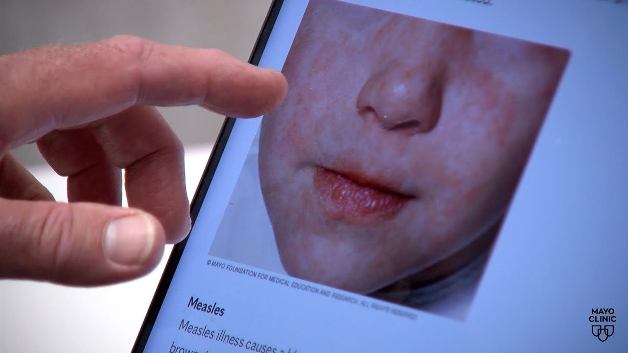 The science behind the measles virus