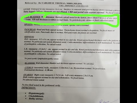 Cholelithiasis
