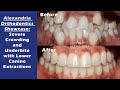 Alexandria Orthodontics Showcase: Severe Crowding and Underbite with Lower Canine Extractions