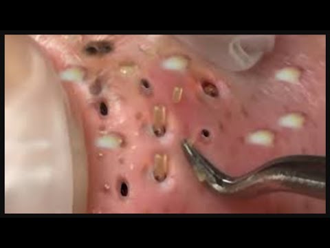 The Importance of Cleansing and Acne Treatment your skin