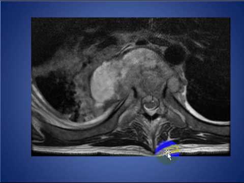 Radiology Rounds 029 Posterior Mediastinum