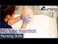 NG (Nasogastric) Tube Insertion Techniques (Nursing Skills)