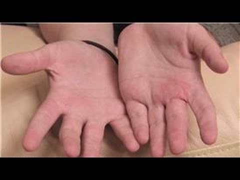 comment traiter eczema paupiere