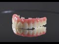 Full Mouth Dental Implants. What You Should Know and Cost