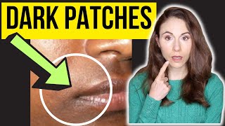 Dermatologist Explains Dark Patches Around The Mouth