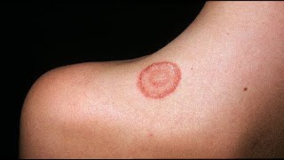 Fastest way to get rid of ringworm!