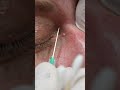 Milia Removal