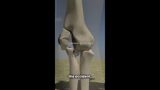 How Visual Animation Helped Secure a $2.3M Verdict