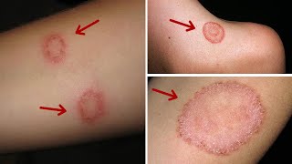 How to Get Rid of Ringworm Overnight || 11 Best Home Remedies for Ringworm On Skin