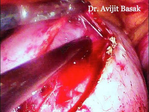 Chocolate Cyst (Endometriotic Cyst) Excision by Laparoscopy
