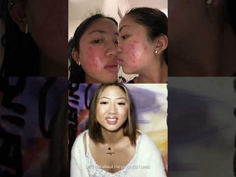 How i cleared up my acne with Benzac #acne #clearskin #Benzac #amcal