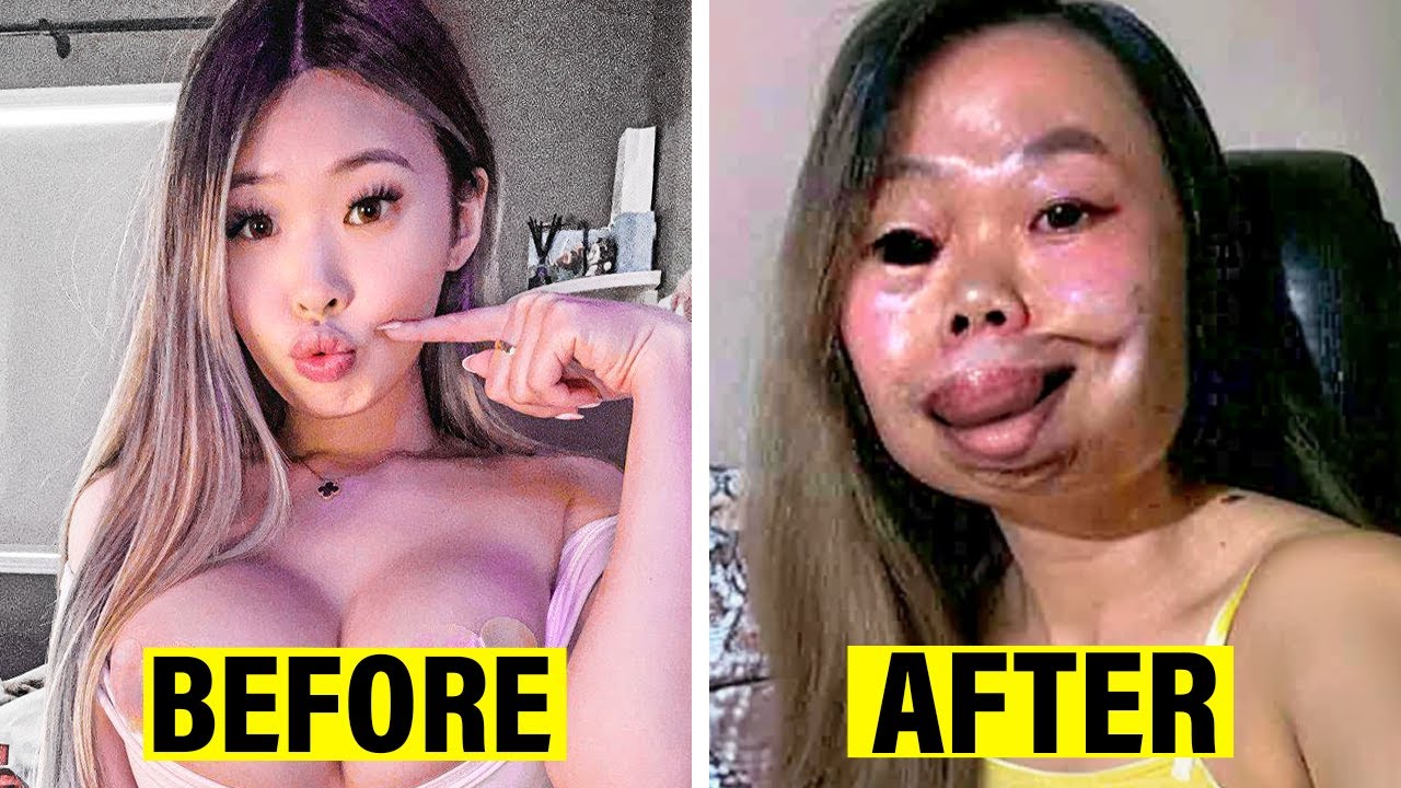 Famous Celebrities Who Destroyed Their Faces With Plastic Surgery!