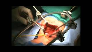 Mini Bookler in Carotid Endarterectomy Dr H Dardik