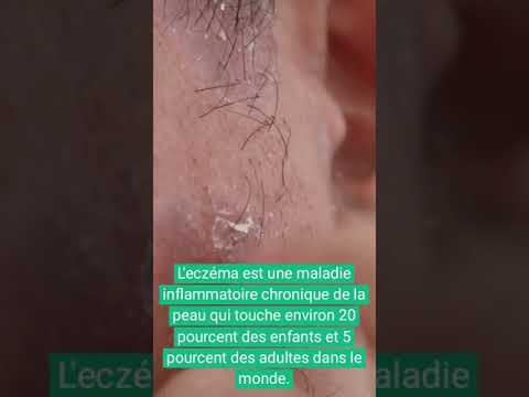 Vidéo : eczéma chronique et lichénification