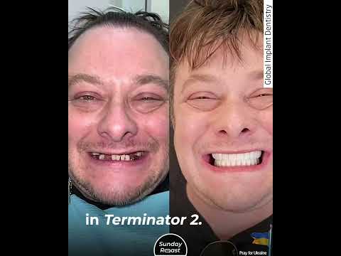 Why the Young Star of Terminator 2 Lost His Teeth