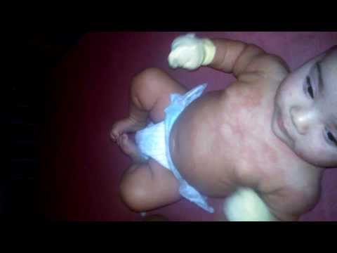 Limpeza de um fígado no momento de respostas de psoríase Unguento contra eczema em uma cara