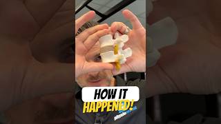 How my Lumbar Disc Bulge happened!
