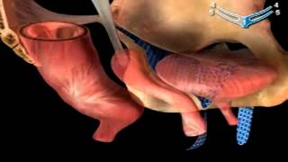 CIRUGIA INCONTINENCIA