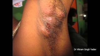 Hidradenitis Suppurativa
