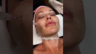 The PRX-T33 Skin Rejuvenation Bring your amazing skin back with CN MEDICAL ❤️