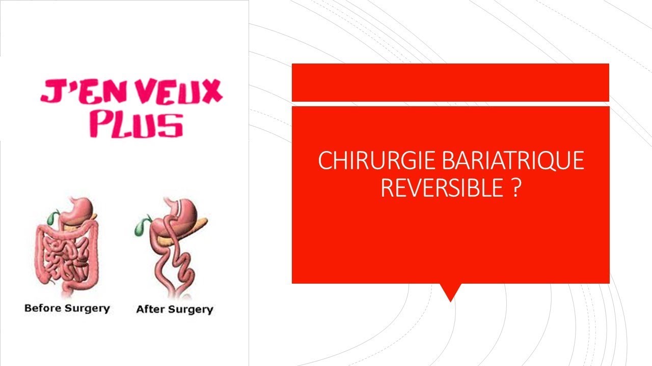 La Chirurgie Bariatrique est elle réversible ?