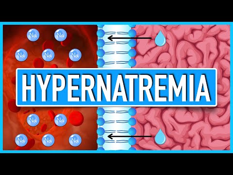 Hypernatremia | Pathophysiology, Etiologies, Consequences, and Treatment