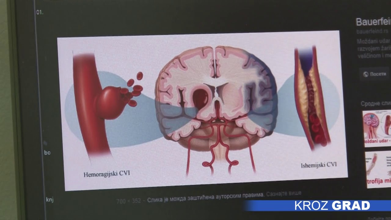 Moždani udar se može sprečiti