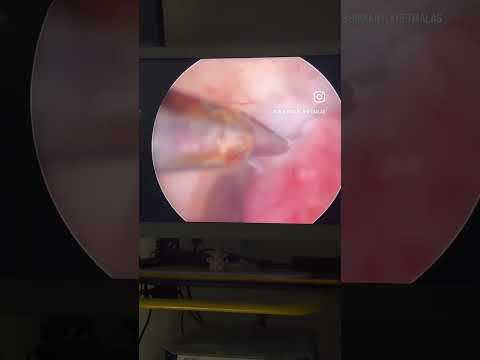 hysteroscopic polypectomy | Dr. Shrikant Khetmalas