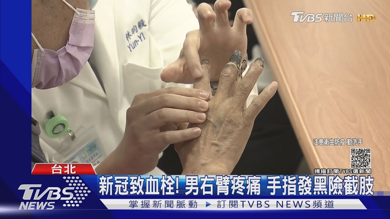 新冠致血栓!男右臂疼痛 手指發黑險截肢