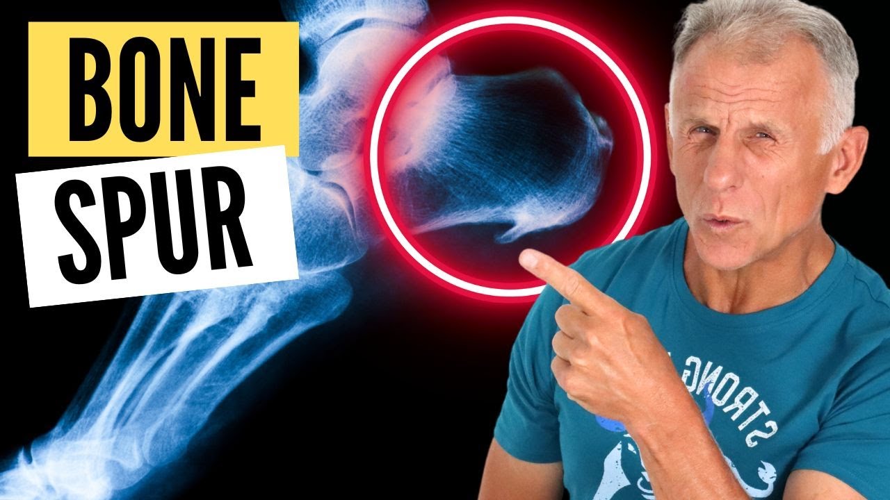 Myth: Bone Spurs Are Painful - YouTube