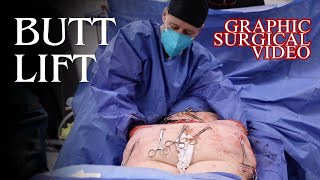 20 Years Ago She Had a Tummy Tuck - Today She Comes in for a Body Lift