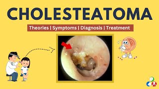 Cholesteatoma - Symptoms, Causes, Theories, Treatment