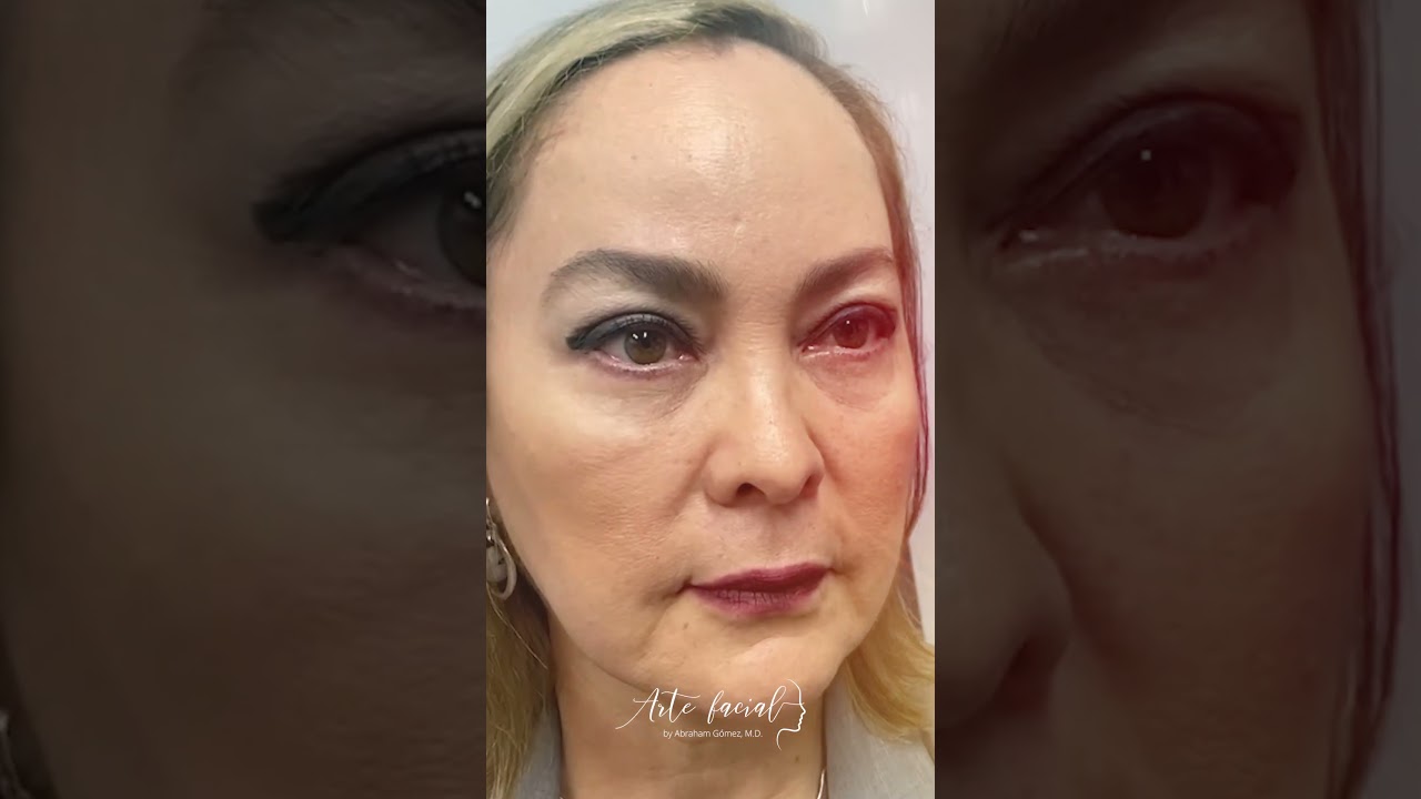 ¿Qué puede hacer para eliminar esa piel del párpado que no le permite ponerse maquillaje? 🤔