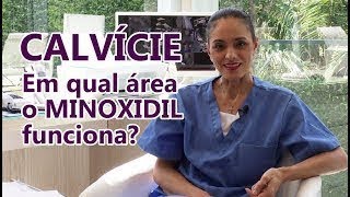Para que tipo de CALVÍCIE serve o MINOXIDIL?