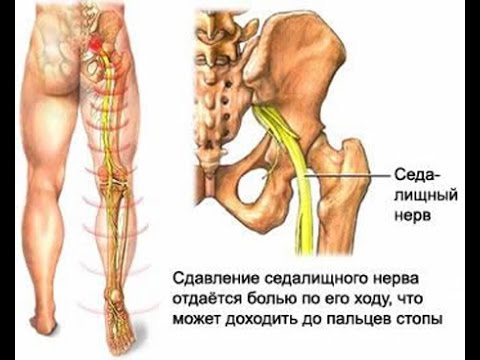 Наколенники на коленного сустава Протрузии в шейном отделе позвоночника симптомы
