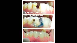 Download lagu Tambal gigi depan yang berlubang besar mp3