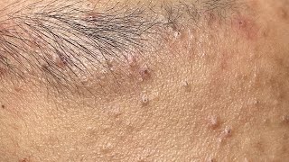 Soothing Facial Treatment for Acne-Prone Skin 644 P2