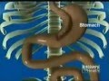 Mini Gastric Bypass Surgery Loop Bypass Animated Video Bariatric Weight Loss