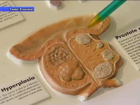 ProstataMassager Apotheken in Jekaterinburg Prostata Ultraschall in Biisk