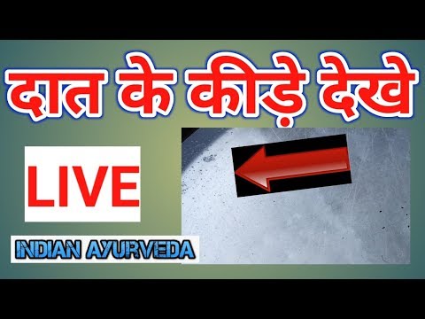 दांत का कीड़ा और दर्द बाहर निकालने का अचूक देशी उपाय लाइव देखे,live/Indian Ayurveda Video