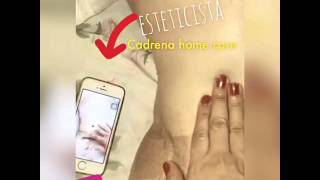 Drenagem linfática  pós operatório ( antes e depois) lipo+abdominoplastia. Cadrena