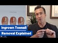 Ingrown Toenail Removal Dr Moore Explains The Permanent Cosmetic Procedure