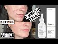 TESTING THE ORDINARY NIACINAMIDE AND ZINC FOR MY ACNE SCARRING FOR 1 MONTH