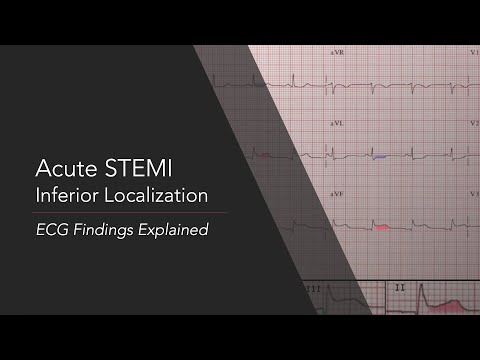 Acute Inferior STEMI: ECG Findings Explained
