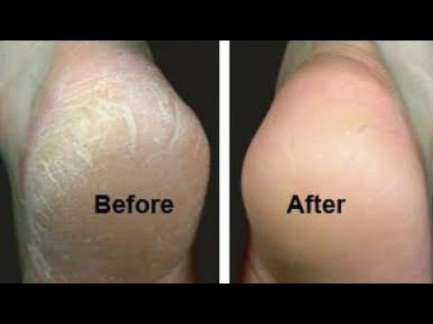 Instant Relief From Cracked Heels/ How To Get Rid Of Cracked Heels Faster With only 2 Ingredients