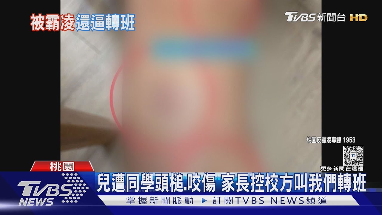 兒遭同學頭槌咬傷 家長控校方叫我們轉班
