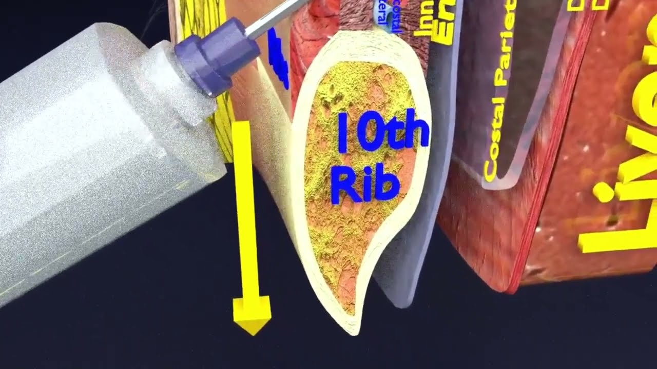 3D thoracic procedures 3D Model