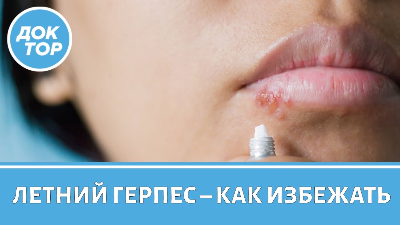 Какие ошибки приводят к летнему герпесу