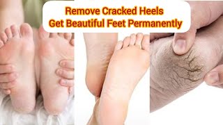 Remove Cracked Heels  | Get Beautiful Feet Permanently
